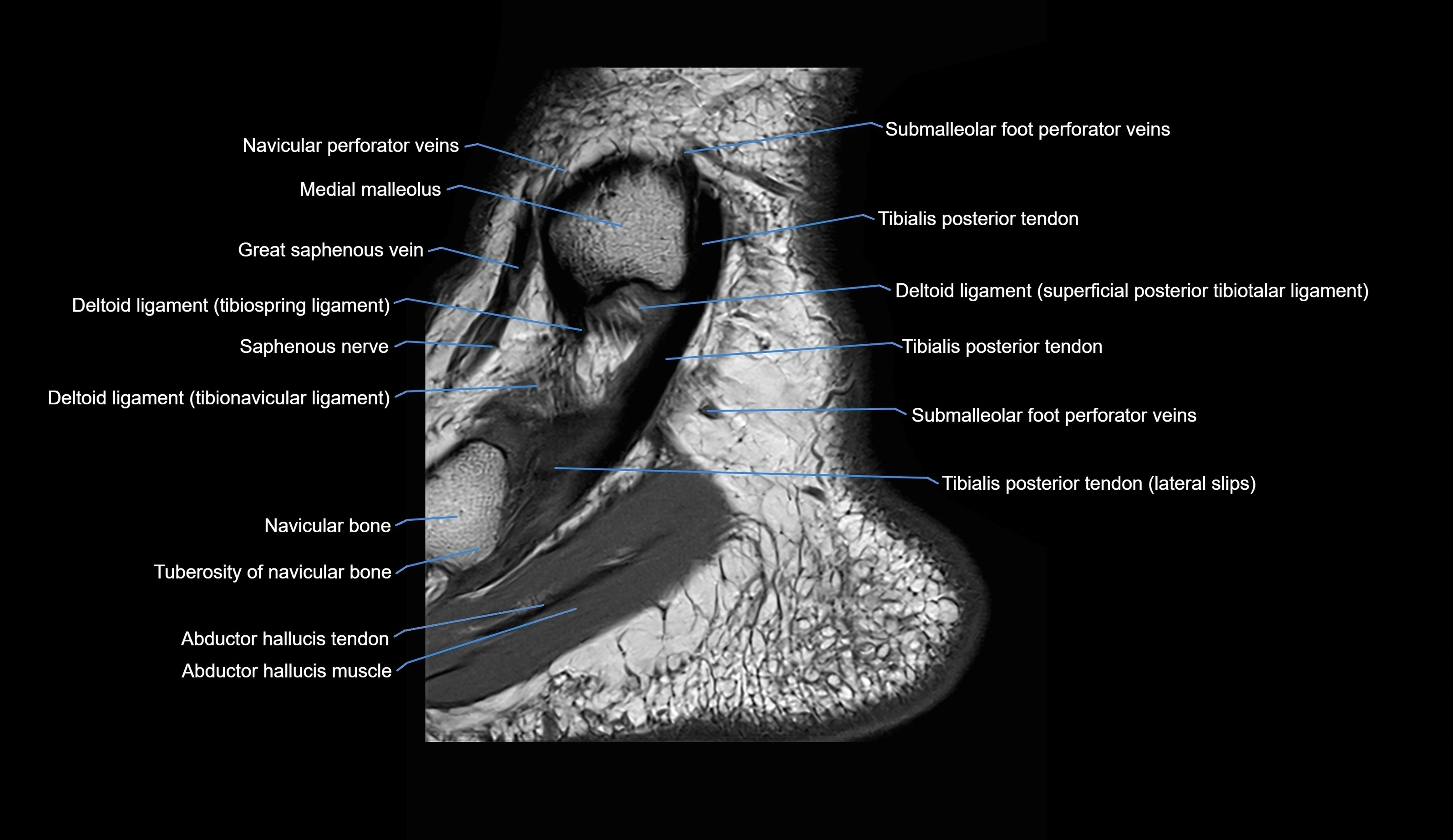 MRI Ankle sagittal cross sectional anatomy 3T  radiology  image-img-00001-00005.webp